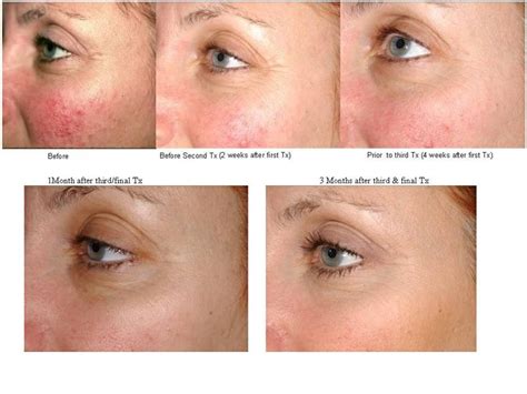 Laser Genesis Before and After photos | Rosacea treatment, Rosacea skin ...