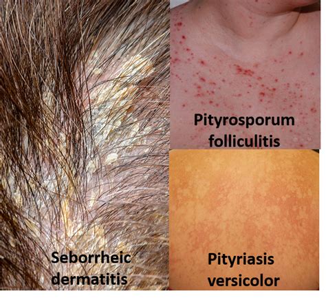 Malassezia Folliculitis, Furfur, Scalp Malassezia Yeast,, 48% OFF