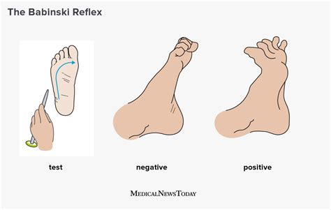 What is the Babinski reflex? | Plantar reflex, Reflexes, Brain test