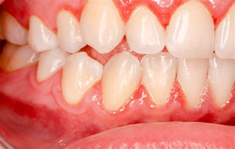 11 Reasons Why Your Gums Are Itchy