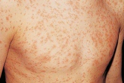 ONE OF HIV SYMPTOMS IS RASH. A VERY IMPORTANT ARTICLE TO READ | by ...