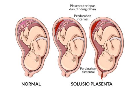 Solusio Plasenta - Gejala, penyebab dan mengobati - Alodokter