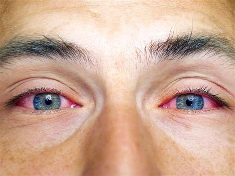 Visible Red or Blue Eye Veins: What To Do About Them? – NVISION Eye Centers