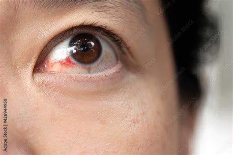 Eye Blood Vessel Hemorrhage | My XXX Hot Girl