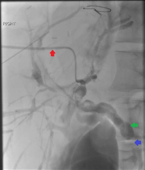 Percutaneous cholangiography demonstrating nonpassage of contrast... | Download Scientific Diagram