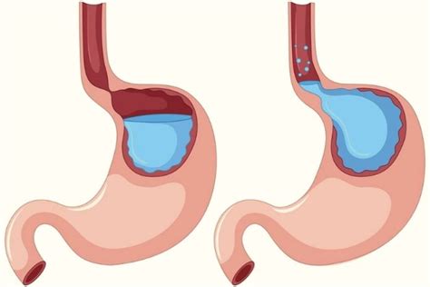 Gastric Reflux Disease (GERD): Causes And Treatments