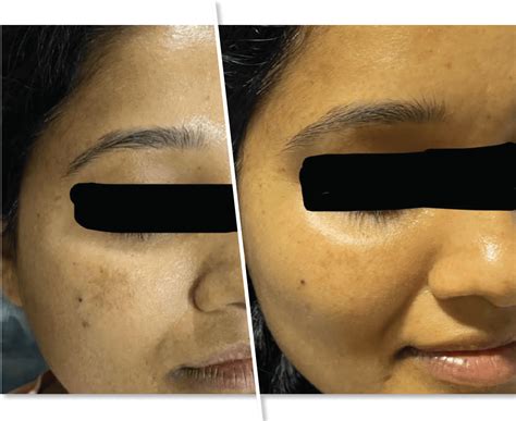 Natural Acne Treatment, Scar Removal in Bangalore, Hyderabad