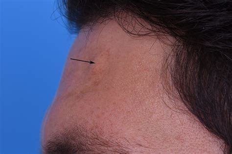 Forehead: Osteoma / Lipoma - Dr. Gassner