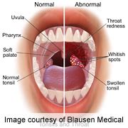 HPV-linked throat cancer may have telltale first symptoms