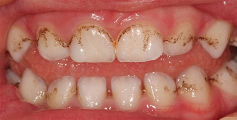 Black Stains on the Teeth: Major Causes and Best Solutions | New Health Advisor