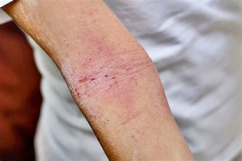 Skin Rash Causes In Adults