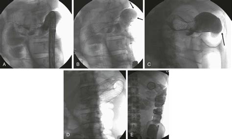 Preoperative and Palliative Colonic Stenting | Radiology Key