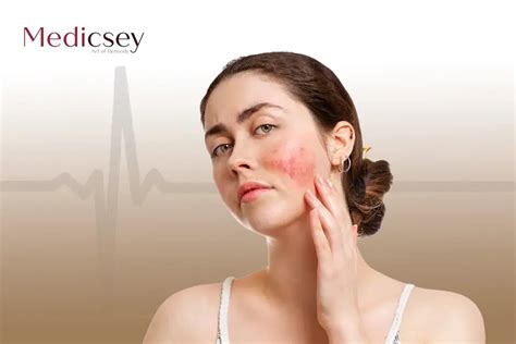 Causes and treatment of butterfly rash in turkey