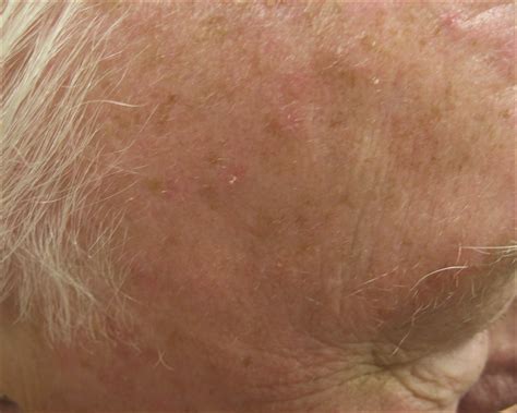 Actinic Keratosis Vs Skin Cancer