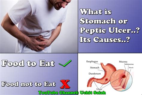 Uchit Salah : Stomach ulcer cure home remedies || Stomach ulcer treatment at home || Peptic ...