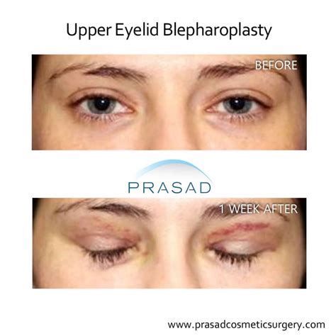 Hooded Eyelid Surgery: Benefits, Results, and Recovery