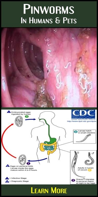 Pinworms | Parasite cleanse, Tape worm in humans, How to treat pinworms