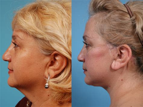 Neck Lift Before and After Pictures Case 142 | Chicago, IL | TLKM Plastic Surgery