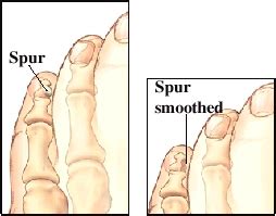 Foot Surgery: Bone Spurs | Saint Luke's Health System