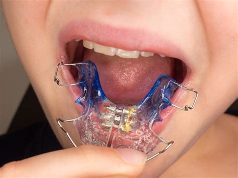 Tongue Thrust Treatment | Buffalo Orthodontist | Free Consultation