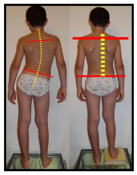 Clinical aspects of functional scoliosis. | Download Scientific Diagram