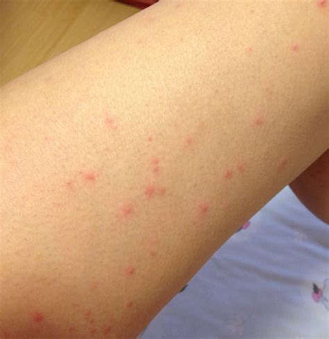 Scabies Skin Rash Images