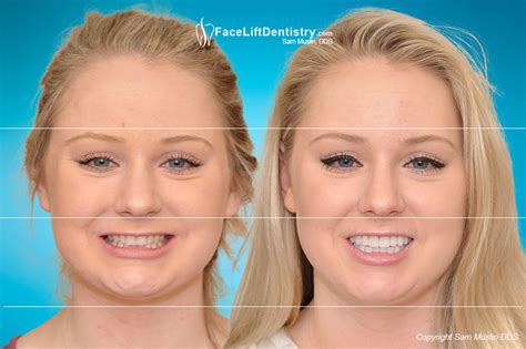 19 Images Luxury Overbite Change Face Shape