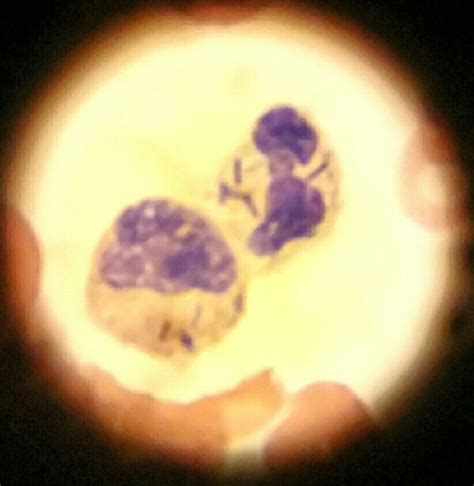 Gram negative bacilli in neutrophils. Taken on my camera phone so sorry about picture quality ...