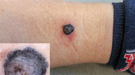 Blood Blister vs. Melanoma: How to Tell the Difference