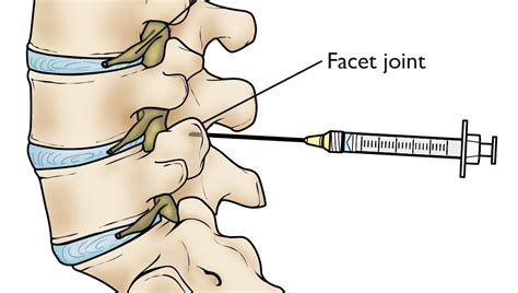 Define Facet Anatomy