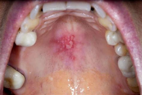 Mouth Ulcer - Causes, symptoms, Treatment & cure - Museum Dental Center