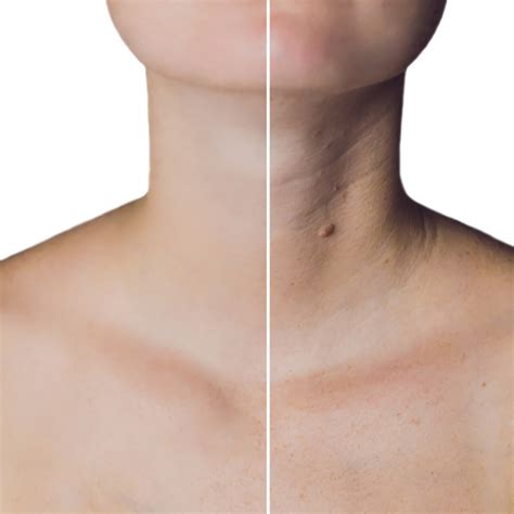 How To Get Rid Of Tech Neck? Micro-Botox is Here to Help! — Urban You ...