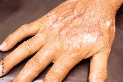 Burn Scars on the hands, Picture of the scar caused by an accident And has a smooth surface ...