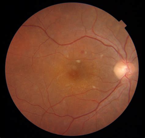 Overview of Hypertensive Retinopathy, its symptoms, Causes & Treatment