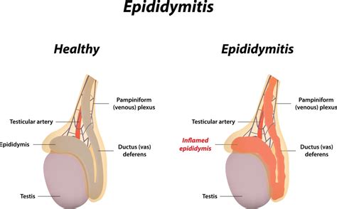 Dealing with an Epididymal Cyst - Facty Health