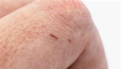 How to remove a splinter: Methods and tips