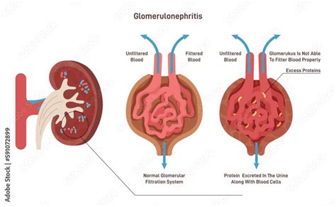 Glomerulonephritis: Causes, Symptoms, Diagnosis Treatment, 46% OFF