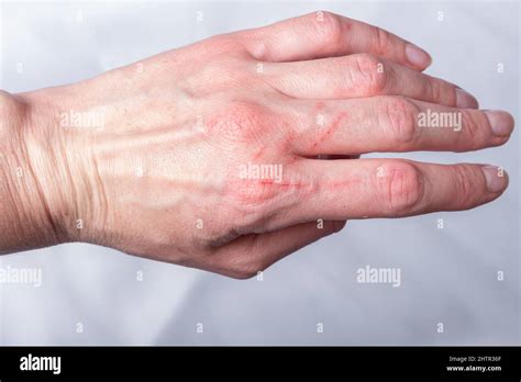 Cat scratch wound woman hi-res stock photography and images - Alamy