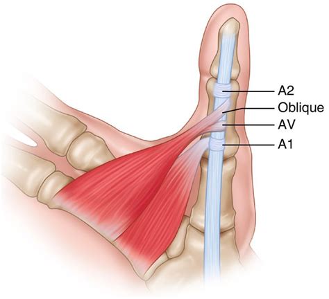 Flexor Tendon | Hand surgery, Trigger thumb, Pediatric patients