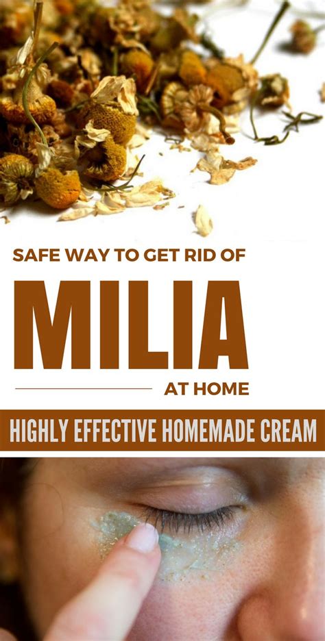 Natural remedies for milia – Prnso