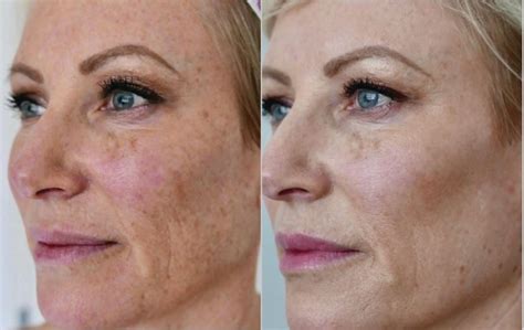 HALO® Laser Skin Resurfacing Before and After Pictures Case 249 | Toronto, ON | Ford Plastic ...