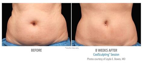 CoolSculpting before and after | Real Patient Photos - Vein & Laser Institute