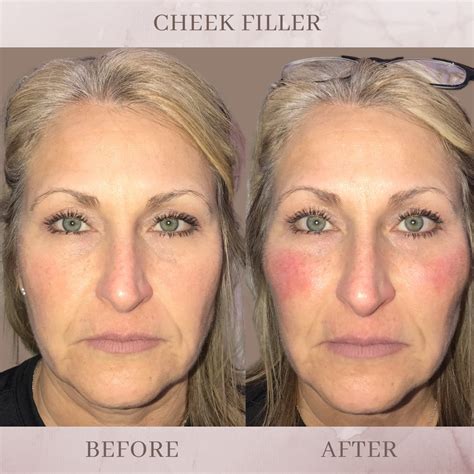 Cheek Filler - Eluma - Laser & Aesthetics