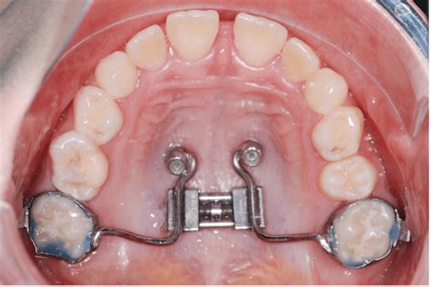 Maxillary Expansion with skeletal anchorage explained: MSE vs Hybrid ...