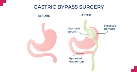 Roux-en-Y Gastric Bypass Perth | Weight Loss Surgery