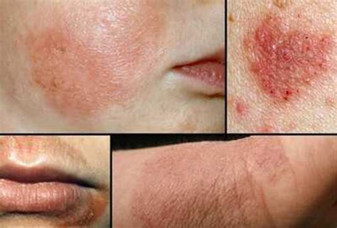 What is Atopic Dermatitis? Symptoms, Causes and Diagnosis