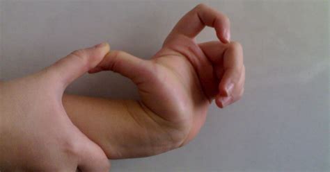 Hypermobility Syndrome Symptoms And Treatment | Health And Beauty