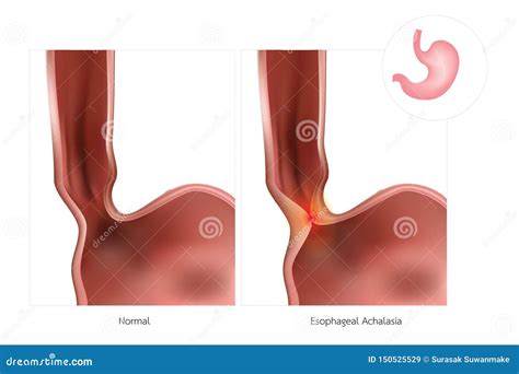 Esophageal Achalasia Disease With Lower Sphincter Failure Outline ...