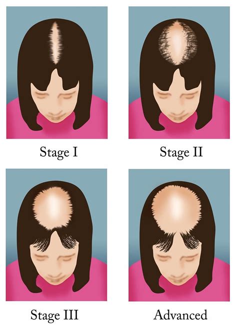 Alopecia Types Types Of Alopecia Alopecia Causes Treatment | My XXX Hot Girl