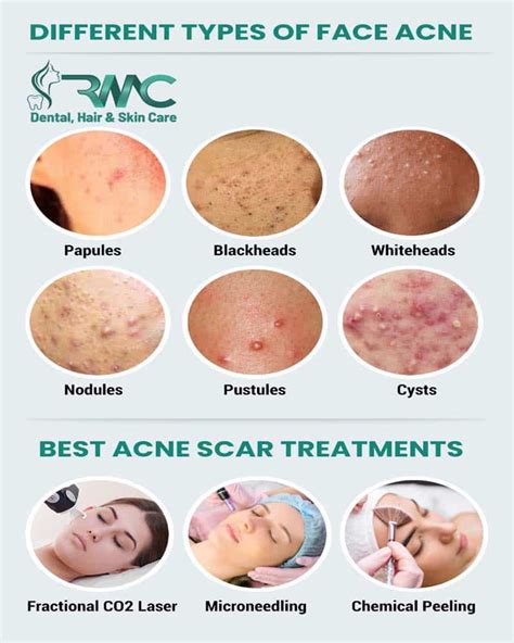 Acne Scars: Types, Causes and Treatment in Islamabad